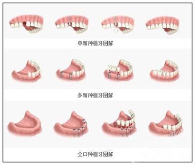 哪些人比較適合做種植牙修復(fù)？