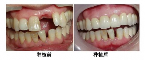 種植牙要多久復診一次？