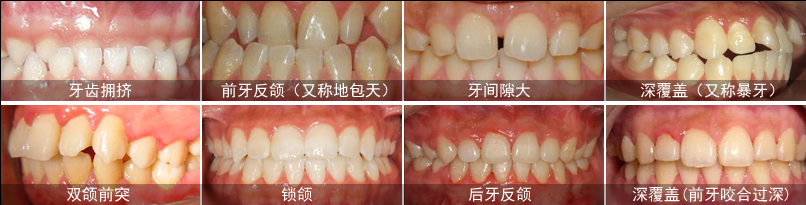 哪些人急需做牙齒矯正？