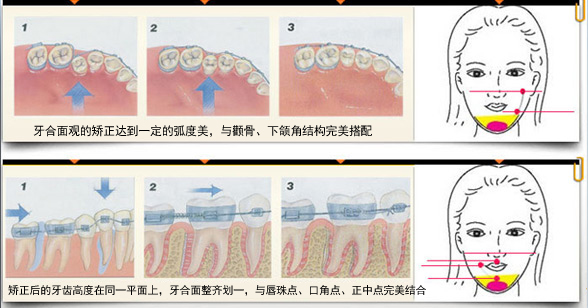 牙齒矯正的原理是什么？