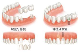 種植牙與傳統(tǒng)的鑲牙有何區(qū)別？