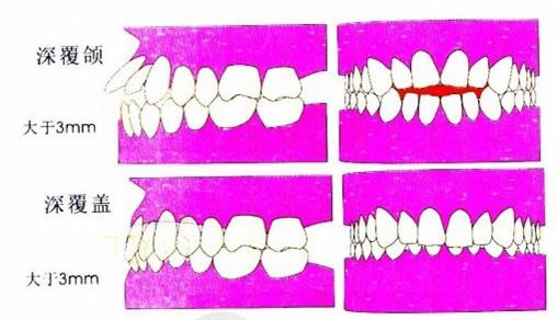 什么是前牙深覆蓋？