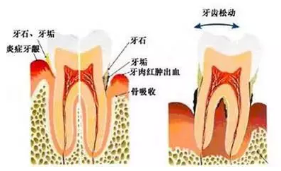 牙齒松動(dòng)可以洗牙嗎？