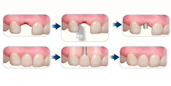 種植牙的周期是怎樣的？