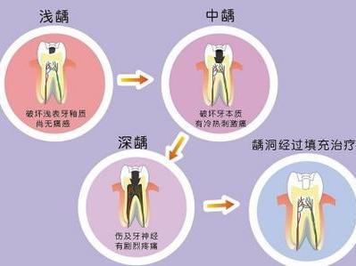 如何知道自己有沒有蟲牙？