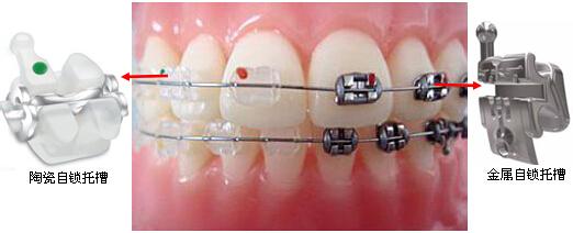 4種牙齒矯正方法對比
