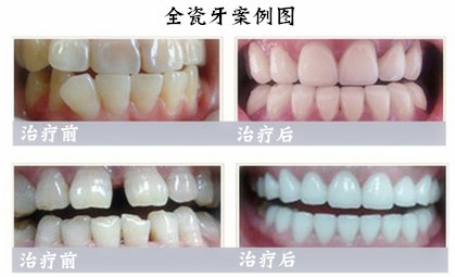 烤瓷牙矯正牙齒的優(yōu)勢有哪些？