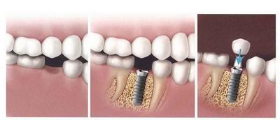 單顆牙缺失怎么修復(fù)比較好？