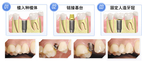 拔牙后為什么要及時做種植牙？