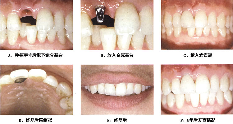 種植牙的主要步驟有哪些？