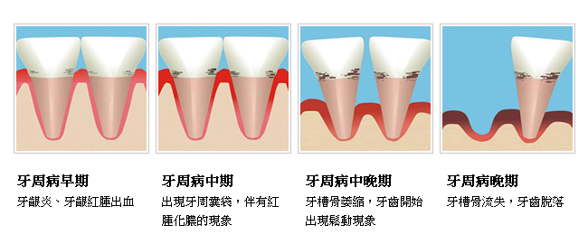 牙周病到底是如何形成的？