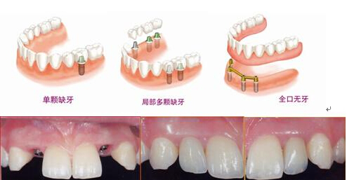 哪些情況下做種植牙比較合適？