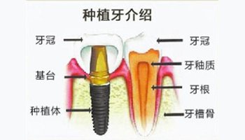 種植牙牙冠松動(dòng)怎么辦？