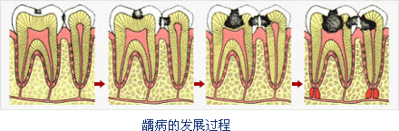 齲齒的類(lèi)型有哪些？