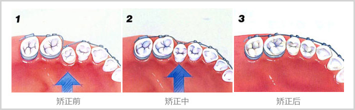 牙齒矯正多久復(fù)查一次？