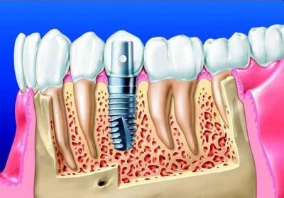 如何提高種植牙的使用年限？