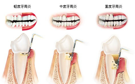 牙周炎治療后會復(fù)發(fā)嗎？