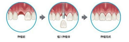 單顆種植牙要注意什么？