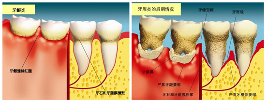 牙齦炎治療后會(huì)復(fù)發(fā)嗎？