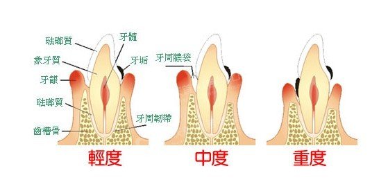 深圳治療牙周炎要多少錢(qián)？