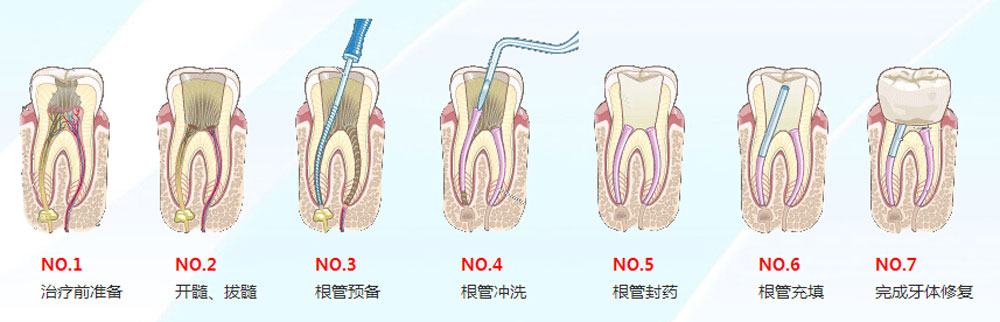 深圳做根管治療一般多少錢？