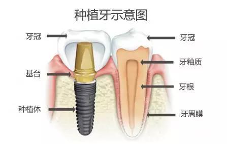 種植牙選什么種植系統(tǒng)比較好？