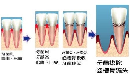 牙周病都有哪些危害？