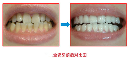 做全瓷牙需要磨牙嗎？