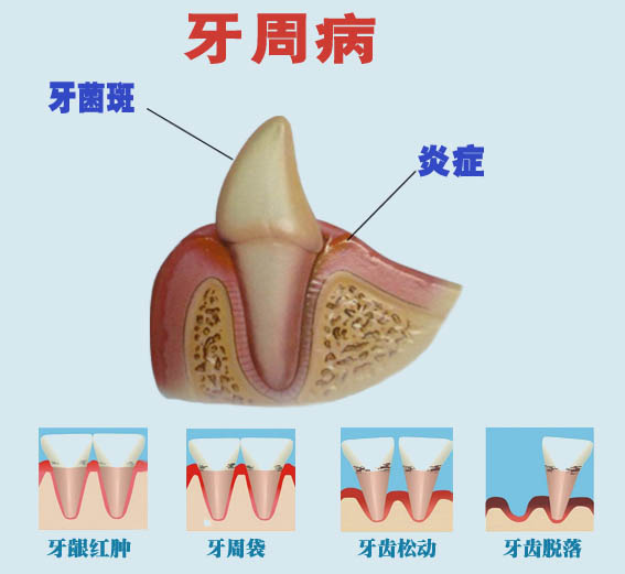 牙周病對人體有哪些危害？