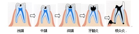 老年人患齲齒有哪些危害？