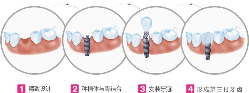 種植牙價格差別大應該怎么選？