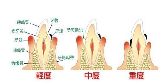 哪些癥狀表明患有牙周炎？