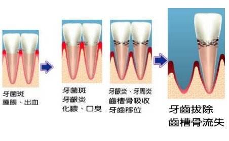 孕期常見(jiàn)的牙周問(wèn)題有哪些？