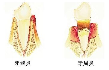 牙齦炎和牙周炎的區(qū)別有哪些？