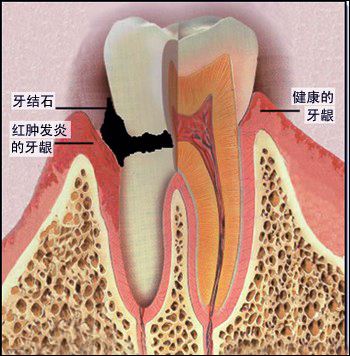 牙齦炎的外在癥狀有哪些？