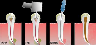 根管治療期間要注意哪些事項？