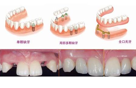 哪些牙齒情況適合做種植牙？
