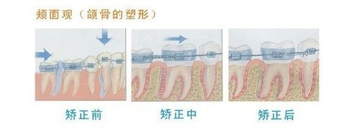 牙齒矯正的原理是什么？