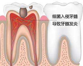 什么是牙髓炎？