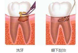 洗牙和牙周刮治有什么區(qū)別？