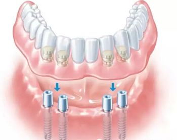 全口牙缺失修復(fù)注意事項(xiàng)