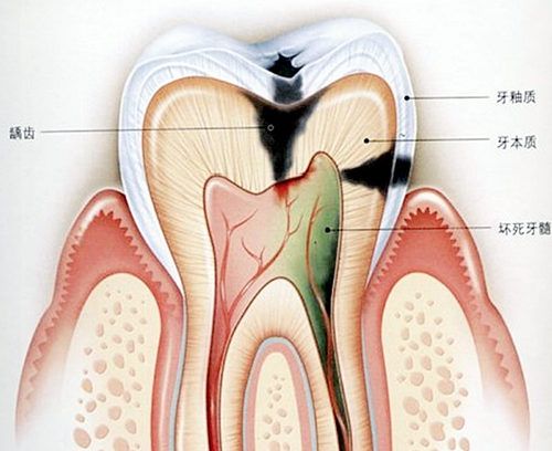 深圳牙髓炎癥狀