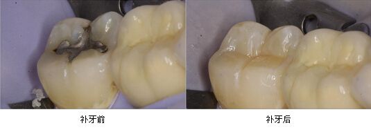 深圳蛀牙補一顆牙多少錢？