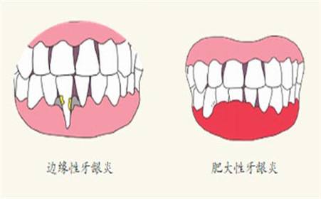 深圳牙齦炎癥狀