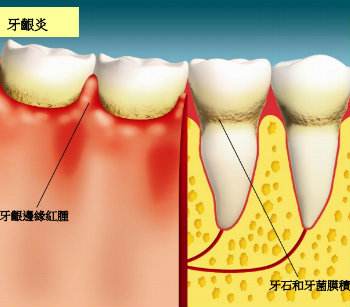 深圳牙齦炎怎么治療？