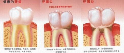 深圳得了牙齦炎怎么治？