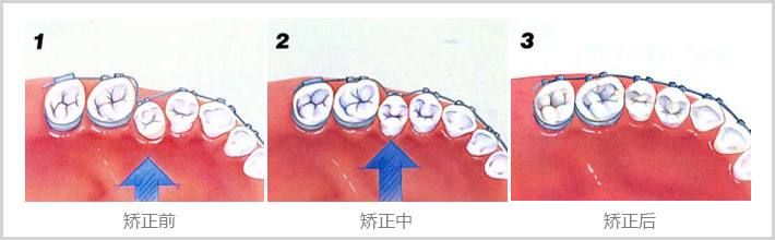 深圳牙齒矯正的較佳年齡