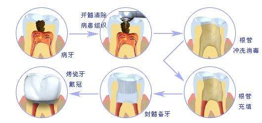 深圳治療牙髓炎要多少錢？