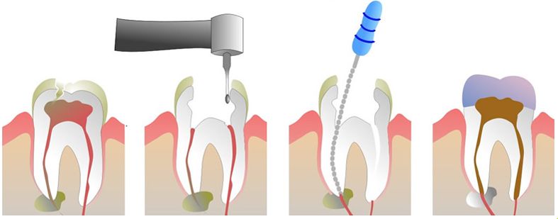 深圳治療牙髓炎方法有哪些？