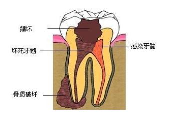 深圳治療急性牙髓炎的方法有哪些？